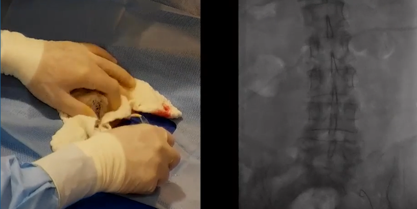 Oclusión de tronco braquicefálico